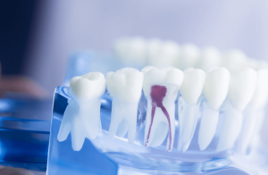 Root Canal Treatment Melbourne CBD
