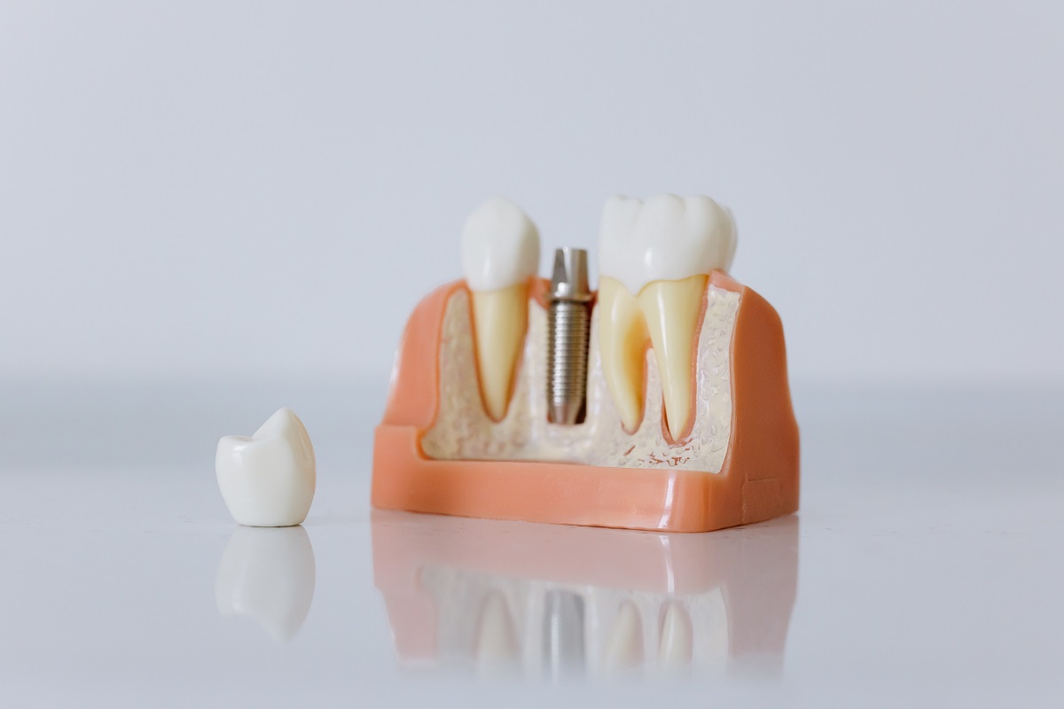 Root Canal Preston